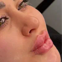بوتاکس فیلرژل لب گونه چانه زاویه فک و صورت مادلینگ|خدمات آرایشگری و زیبایی|تهران, تهرانپارس غربی|دیوار