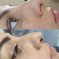 تزریقات زیبایی|خدمات آرایشگری و زیبایی|قرچک, مهدیه|دیوار