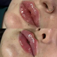تزریق ژل و چربی، بوتاکس،هایفو|خدمات آرایشگری و زیبایی|مشهد, بهشت|دیوار