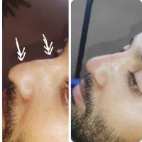 لیفت ابرو وشقیقه با جراحی ۸م .بوتاکس۶۰۰|خدمات آرایشگری و زیبایی|مشهد, شهید فرامرز عباسی|دیوار
