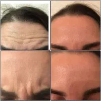 بوتاکس فیلر بلفاروپلاسی تزریق چربی نخ لیفت فشیال|خدمات آرایشگری و زیبایی|اصفهان, ملک‌شهر|دیوار
