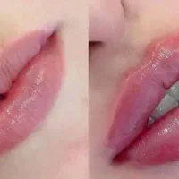 تزریق ژل و آنزیم غبغب وبینی وتزریق آنزیم تخلیه ژل|خدمات آرایشگری و زیبایی|اردبیل, |دیوار