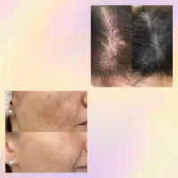 لابیاپلاستی اگروزوم prpبوتاکس مدل برای فیلر بیکینی|خدمات آرایشگری و زیبایی|مشهد, سرافرازان|دیوار
