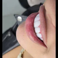 کامپوزیت/لمینیت/روکش/نقد و اقساط
