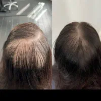 تابستون پر موی رو شروع کن