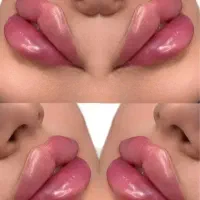 تزریق ژل بوتاکس فیلر فشیال در کلینیک زیبایی