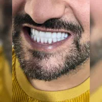 دندانسازی دندانپزشکی ایمپلنت کامپوزیت پروتز ثابت