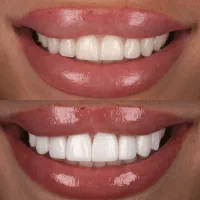 تخفیف ویژه تابستانه