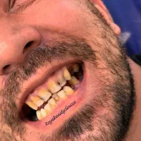 آموزش کامپوزیت تزریق چربی ژل و بوتاکس و لیفت با نخ