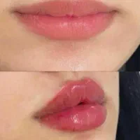 of تا فرداژل و بوتاکس مزو ژل مزو تراپی  prp|خدمات آرایشگری و زیبایی|مشهد, امام رضا (ع)|دیوار