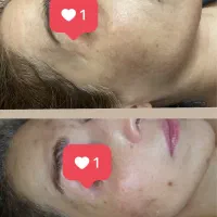 درمان قطعی لک و جوش در کوتاهترین زمان|خدمات آرایشگری و زیبایی|مشهد, چهارچشمه|دیوار