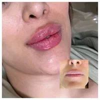 تزریق ژل/بوتاکس،پی آر پی ،سوراخ گوش مطب|خدمات آرایشگری و زیبایی|مشهد, شفا|دیوار