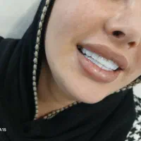 کامپوزیت فکی ۶ت|خدمات آرایشگری و زیبایی|تهران, شهرک شریعتی|دیوار