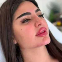 ژل و بوتاکس صورت|خدمات آرایشگری و زیبایی|فولادشهر, مسکن مهر فولادشهر|دیوار