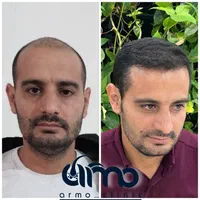 کاشت مو ابرو ریش تکنسین شیرازی|خدمات آرایشگری و زیبایی|قزوین, |دیوار