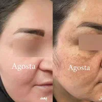 پک ضد لک تخصصی با قدرت آبرسانی بالا