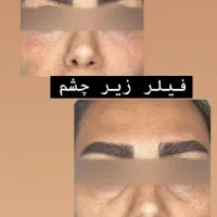 ژل بوتاکس آنزیم مزوتراپی پرسینگ فشیال فیلر|خدمات آرایشگری و زیبایی|مشهد, صیاد شیرازی|دیوار
