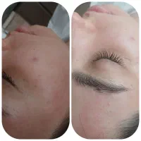پاکسازی تخصصی پوست با دستگاه هیدرو فیشیال 190 ت