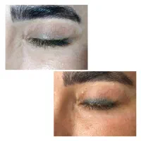 ریمو تک جلسه ای وآنزیم تراپی رشد ابرو