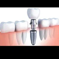 ایمپلنت (دندان ثابت) با بالاترین کیفیت وقیمت خیریه