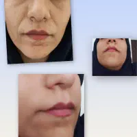 تزریق فیلر با تخفیف ۵۰ درصدی