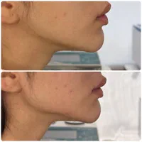 فیلر ‌بوتاکس ژل لب روسی کانتورینگ|خدمات آرایشگری و زیبایی|تهران, جمهوری|دیوار