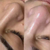 پاکسازی پوست و مزونیدلینگ و پلاسما