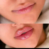 آفر ویژه فیلر -مزو جوانسازی-بوتاکس چشم گربه ای