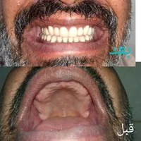 ساخت دندان مصنوعی اقتصادی با خدمات در منزل|خدمات آرایشگری و زیبایی|ری, دیلمان|دیوار