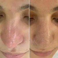 خدمات تخصصی پوست و زیبایی صورت ۵۰٪آف تا فردا|خدمات آرایشگری و زیبایی|مشهد, دانشجو|دیوار