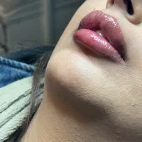 تزریق ژل لب وکانتورینگ(+بوتاکس رایگان