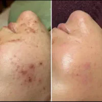 فیشیال صورت و کربوکسی تراپی