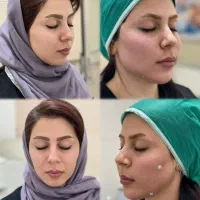 تزریق چربی،بلفارو،لیفت شقیقه وکامل صورت،ساکشن چربی