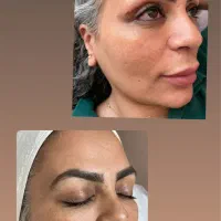 درمان قطعی لک و جوش در کوتاهترین زمان|خدمات آرایشگری و زیبایی|مشهد, چهارچشمه|دیوار