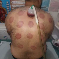 حجامت زالو فصد