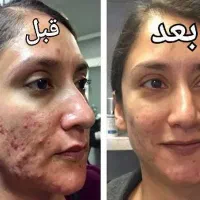 درمان جوش با بهترین روش و محصول|آرایشی، بهداشتی، درمانی|اهواز, ۲۰۰۰واحدی|دیوار