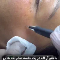 حذف لک فقط و فقط در یک جلسه