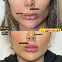 جشنوار بلفاروپلاستی-غبغب-بوکال فت-سانترال لب|خدمات آرایشگری و زیبایی|تهران, پاسداران|دیوار