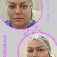 تزریق چربی ،فیلر بادی،عمل پلک،ژل و بوتاکس|خدمات آرایشگری و زیبایی|تهران, صادقیه|دیوار