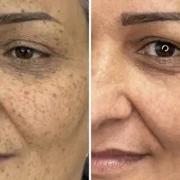 رفع کک مک یک جلسه/جوش/جای جوش/فشیال/مزونیدلینگ