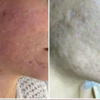 خالبرداری پلاسما درمان ککُ مک و منافذ فیشیال تخصصی|خدمات آرایشگری و زیبایی|مرودشت, گندم‎|دیوار