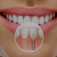 ایمپلنت کره ای