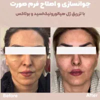 تزریقات. و جوانسازی پوست با فیلر و بوتاکس|آرایشی، بهداشتی، درمانی|اهواز, زیتون کارگری|دیوار