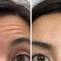 بوتاکس صورت بانوان