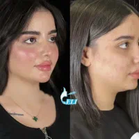 فیلر لب و بوتاکس با پنجاه درصد تخفیف