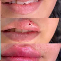 تخصصی ژل و بوتاکس