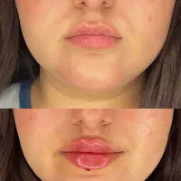 تزریق فیلر بدن وصورت فقط ۶۹۰۰ تخفیف۸۰درصدی|خدمات زیبایی و سلامت|تهران, صاحب الزمان|دیوار