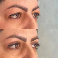 رفع افتادگی دائمی پلک( بلفاروپلاستی لیزری 9.900)