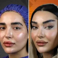 جشنواره یلدایی ژل لب کانتورینگ مزوژل لیفت صورت