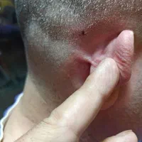 برداشت خال بالیزر بدون خون ریزی در یک جلسه|خدمات آرایشگری و زیبایی|ایلام, |دیوار